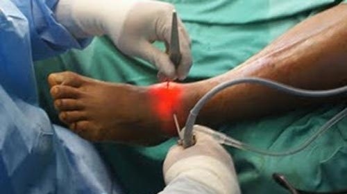 THÔNG TIN CẦN BIẾT &#8211; Phẫu thuật nội soi khớp cổ chân