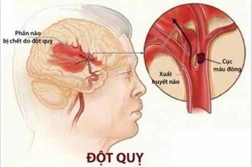 Cứ mỗi phút bệnh nhân đột quỵ không được điều trị đặc hiệu thì có khoảng 2 triệu nơron thần kinh mất đi.