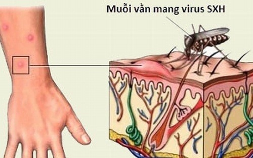 Muỗi là nguyên nhân gây sốt xuất huyết