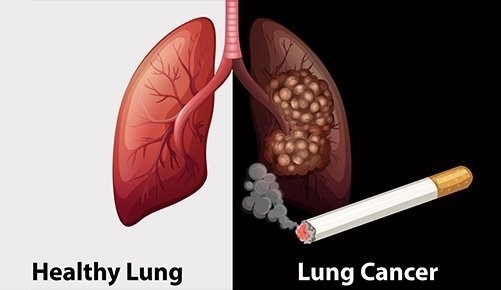 Ung thư phổi là một trong những bệnh ung thư nên tầm soát, đặc biệt ở những người hút thuốc lá nhiều năm