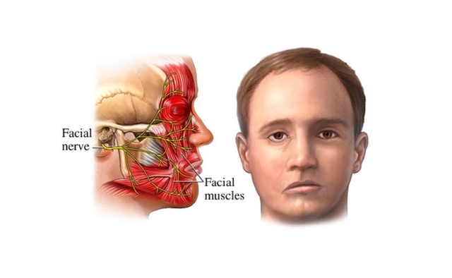 Liệt dây thần kinh số 7 phải làm sao?