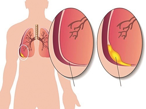 Tràn dịch màng phổi có lây không?