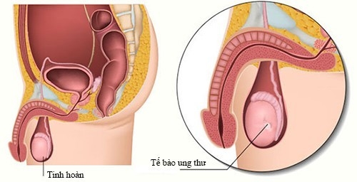 Tìm hiểu về ung thư tinh hoàn phổ biến ở nam giới từ 20 &#8211; 35 tuổi