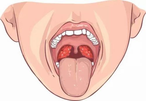 Những kiến thức bạn cần biết về viêm amidan cấp tính