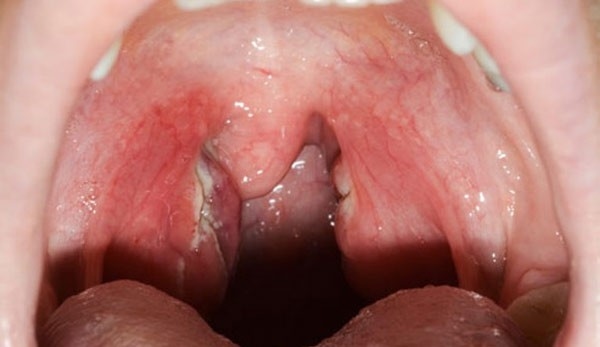 Các dấu hiệu chứng tỏ bạn đã mắc viêm Amidan mạn tính