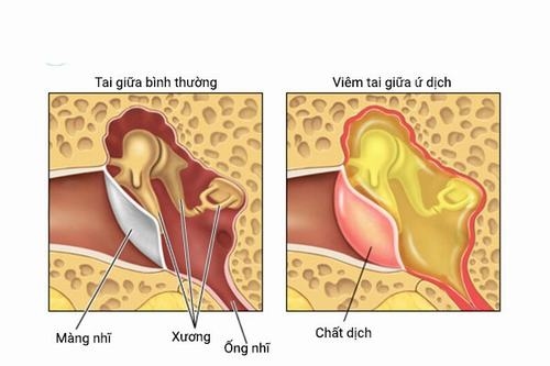 Viêm tai giữa ứ dịch điều trị như thế nào?