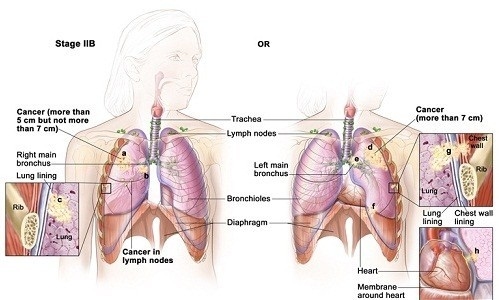 Việc xét nghiệm ung thư phổi sẽ giúp chẩn đoán được giai đoạn bệnh cụ thể, giúp hỗ trợ điều trị bệnh hiệu quả