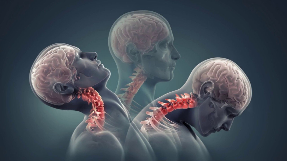 Bệnh thoái hóa não và cách điều trị