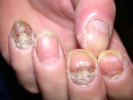 Nếu nấm do Dermatophytes gây ra trên từng móng, tổn thương tấn công từ bờ vào sẽ không bị viêm quanh móng.