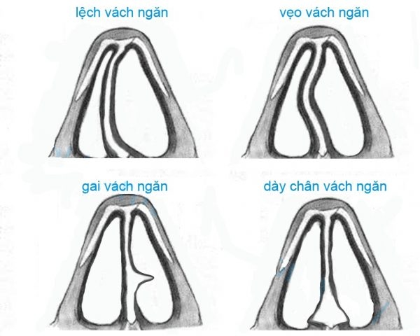 chinh-vach-ngan-mui-1
