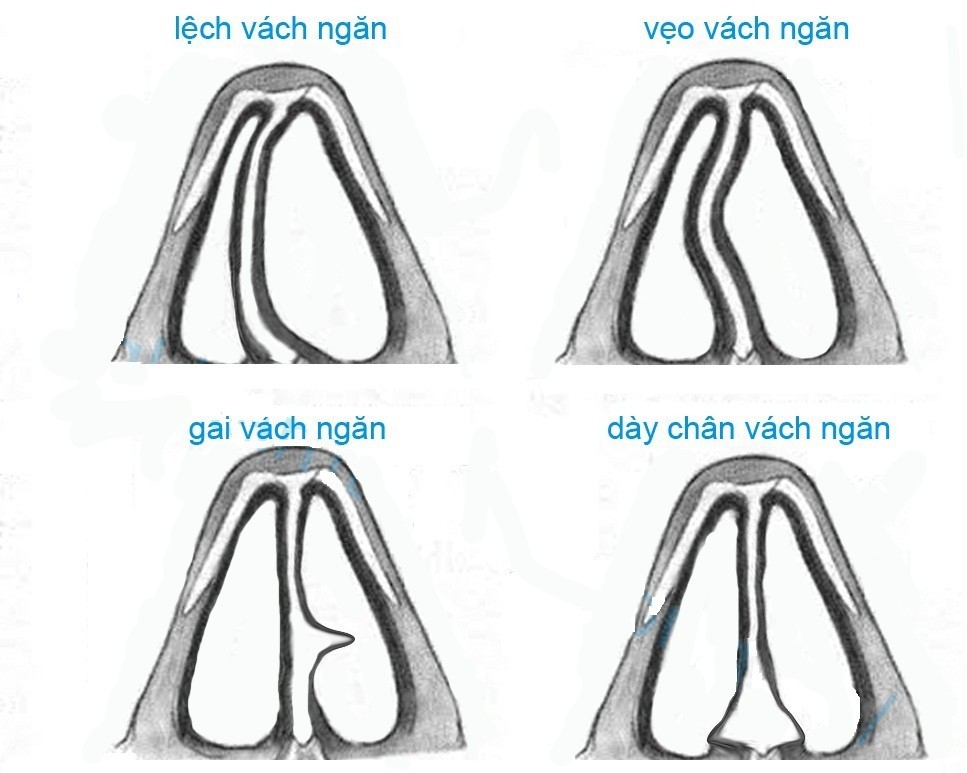 Chỉnh hình vách ngăn mũi được thực hiện như thế nào?