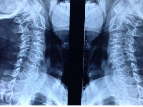 Chụp X quang giúp phát hiện tình trạng thoái hóa