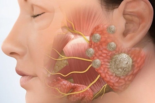 Dấu hiệu ung thư tuyến nước bọt