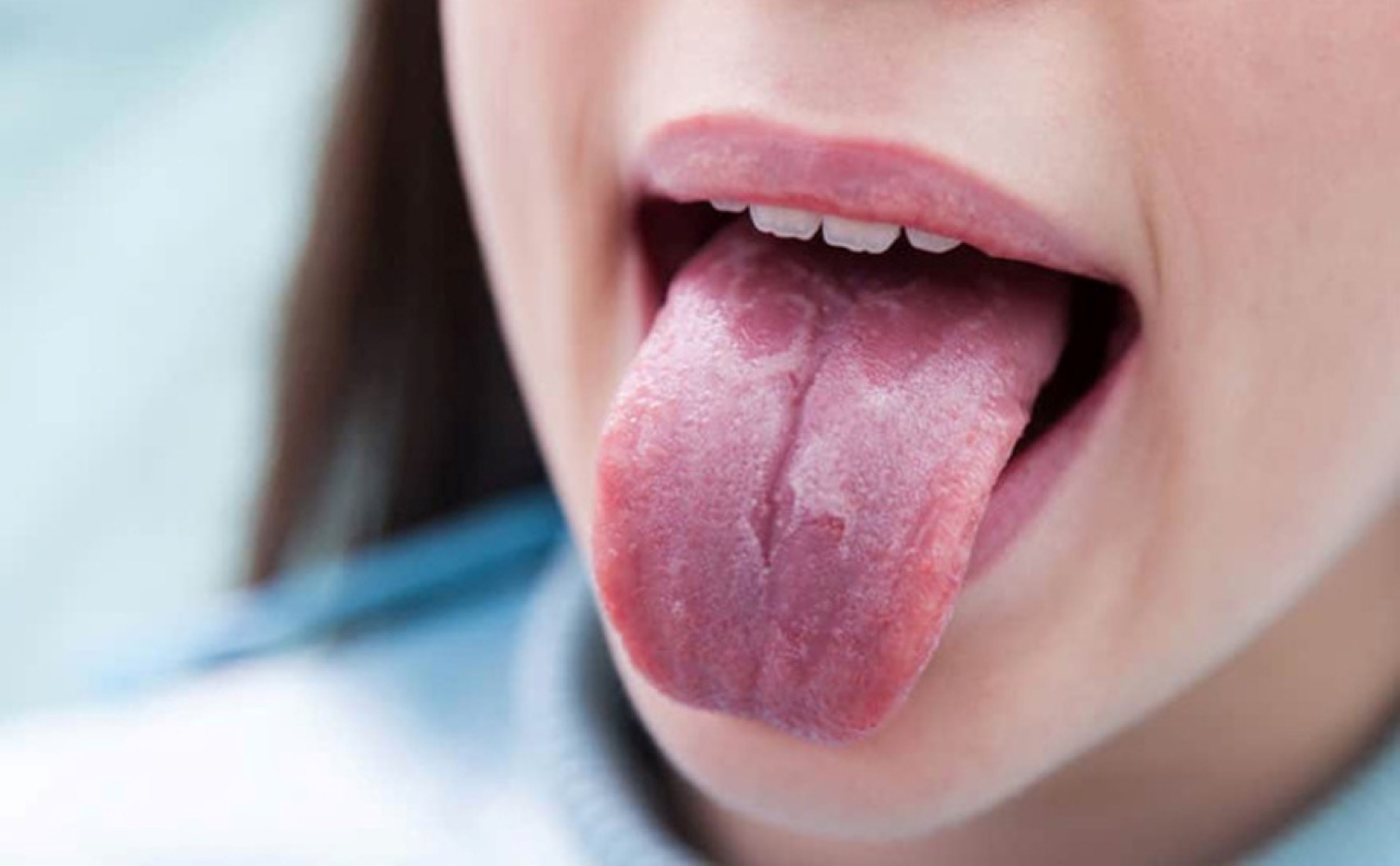 Điều trị nấm lưỡi hiệu quả bằng cách nào?