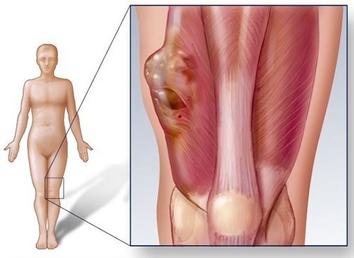 Hình ảnh ung thư mô mềm biến chứng nguy hiểm