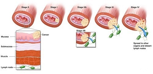 Hình ảnh ung thư vòm họng qua các giai đoạn