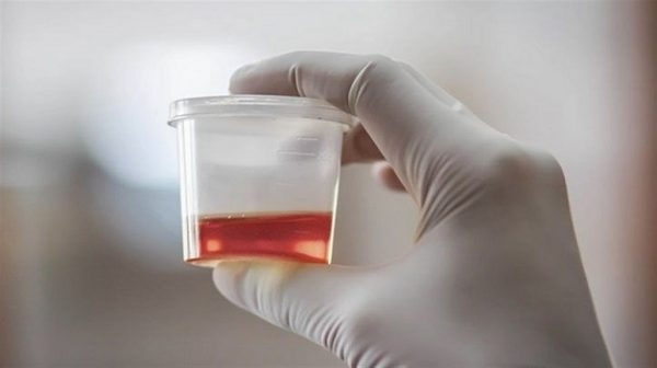 hồng cầu trong nước tiểu là gì?