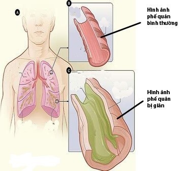 Giãn phế quản là tình trạng các phế quản của phổi bị giãn khó hồi phục.