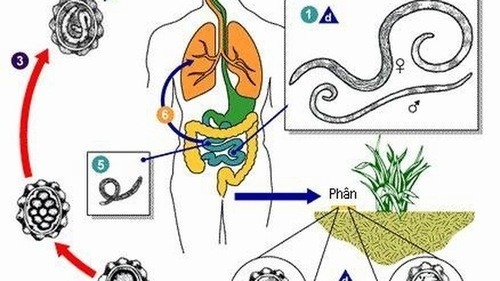Giun chui ống mật cần được phát hiện sớm và điều trị hiệu quả