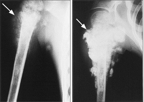 Sarcoma tạo xương là bệnh lý xương khớp nguy hiểm bao gồm các khối u tế bào khổng lồ, sacom xương, sụn và tủy đa phát