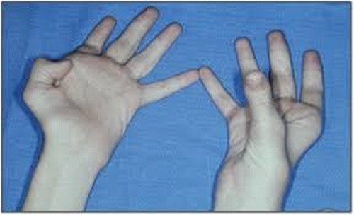 Triệu chứng liệt dây thần kinh trụ