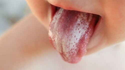 điều trị nấm lưỡi