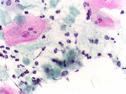 Nhiễm nấm Candida có nguy hiểm không?