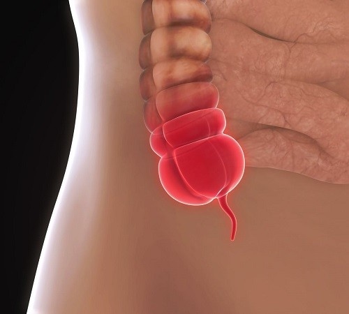 phẫu thuật viêm ruột thừa 