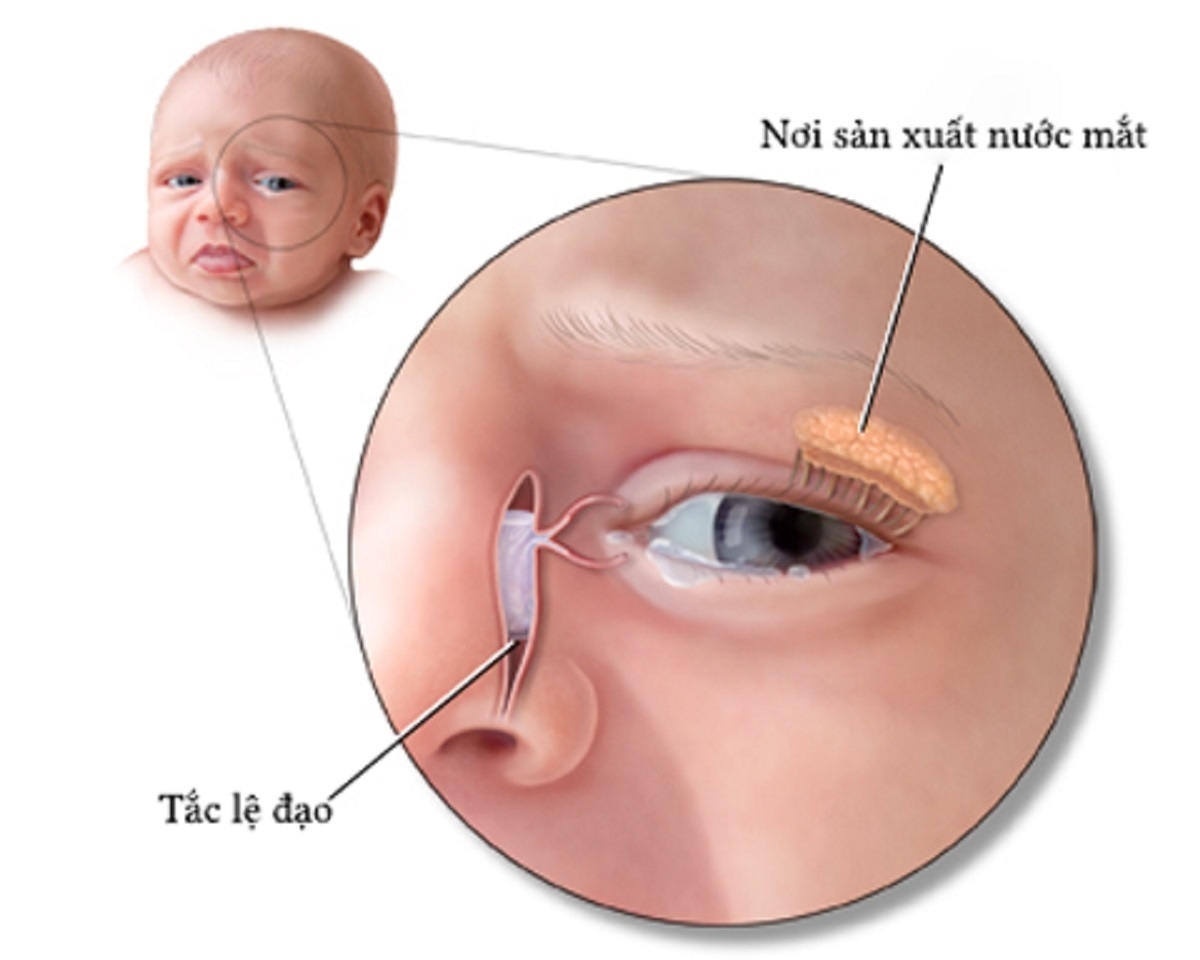 Thông lệ đạo: giải pháp giúp giải quyết bệnh tắc tuyến lệ