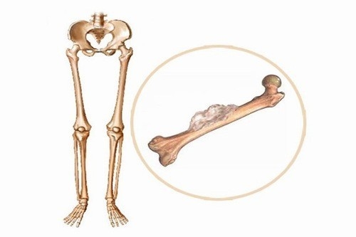 Triệu chứng của ung thư xương có xu hướng tăng nhanh