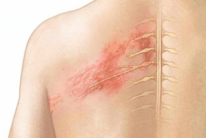 Zona thần kinh thường khu trú tập trung ở có một bên của cơ thể, dọc theo các đường dây thần kinh