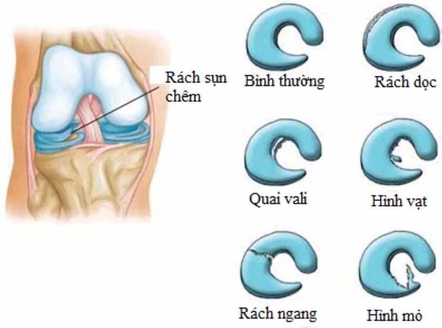 Chi phí mổ rách sụn chêm bao nhiêu?