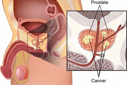 PSA giúp chẩn đoán, theo dõi điều trị và tái phát ung thư tuyến tiền liệt