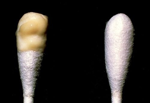 Khí hư ra nhiều và đặc là bị gì?