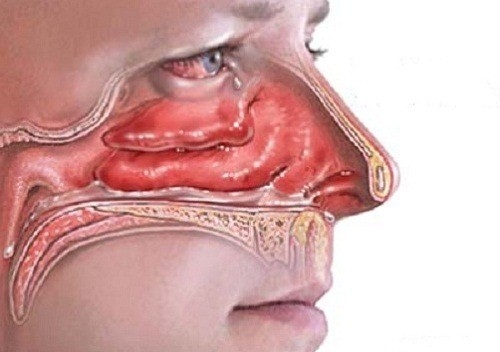 Polyp mũi cần được phát hiện sớm và điều trị hiệu quả