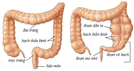 giãn đại tràng ở thai nhi là một dị tật làm yếu ruột già, có thể khiến người bệnh không có khả năng bài tiết phân hợp lí, gây ra tắc nghẽn.