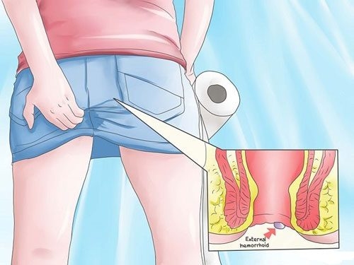 Những tác hại của bệnh trĩ ngoại &#8211; trĩ nội