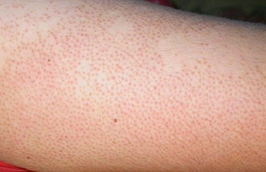 Viêm lỗ chân lông là do các vi khuẩn trú ngụ ở nang lông phát triển mạnh.