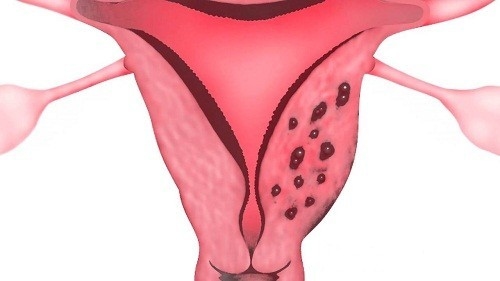 Bệnh lạc nội mạc tử cung là căn bệnh phụ khoa khá nhiều chị em gặp phải