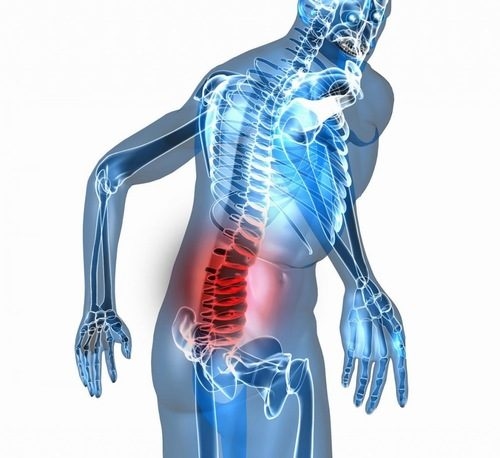 Đau lưng có nên giác hơi Không &amp; Phương pháp hỗ trợ điều trị bệnh
