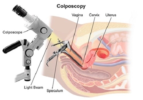 Đốt polyp cổ tử cung là phương pháp hỗ trợ điều trị hiệu quả, dứt điểm cho các trường hợp bệnh nặng