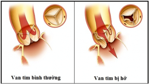 Hở van tim 2 lá là bệnh nguy hiểm cần được phát hiện sớm và điều trị hiệu quả