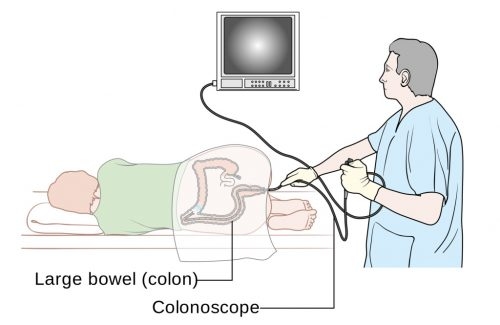 Nội soi đại tràng gây mê sẽ giúp người bệnh thoải mái trong suốt quá trình nội soi
