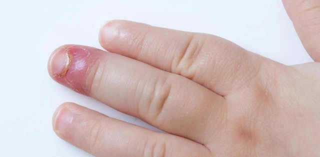 Ngón tay bị sưng đỏ đau nhức là bệnh gì?
