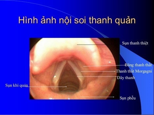 Nội soi thanh quản có đau không?