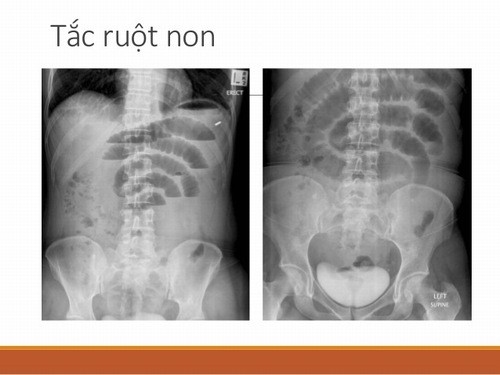 Tắc ruột non cần được phát hiện sớm và điều trị hiệu quả