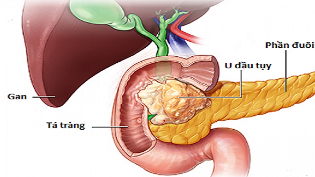 U tụy là gì? Các dạng thường gặp, nguyên nhân và triệu chứng
