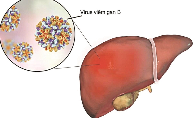 Siêu âm có phát hiện ung thư gan hay không?