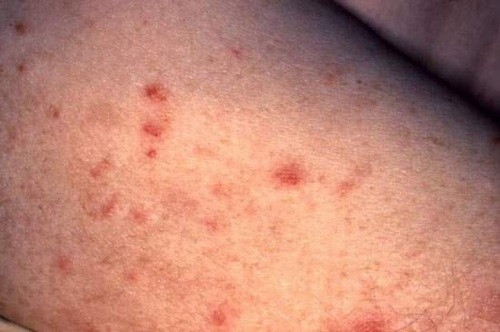 Biểu hiện bệnh giang mai cần được phát hiện sớm và điều trị hiệu quả