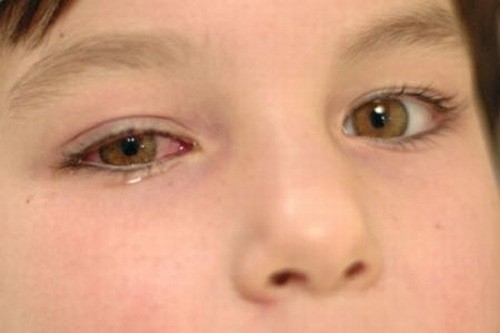 12 dấu hiệu ở mắt &quot;tố cáo&quot; bệnh